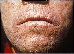 The skin of an adult face that is thickening with a waxy or leathery appearance, also with areas of hyperkeratosis